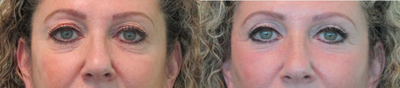 55-64 year old woman treated with Upper Eyelid Surgery and Fractional CO2 Laser Under Eyes - This woman presented with the complaint of heavy eyelids along with excessive wrinkling under her eyes. Under local anesthesia and oral sedation with xanax, we performed an upper blepharoplasty and lower eyelids fractional CO2 treatment. This was performed in our Center in about an hour. Sutures were removed on the sixth day after procedure, and she was able to start using makeup under her eyelids (to cover pinkness from laser) one week after procedure.