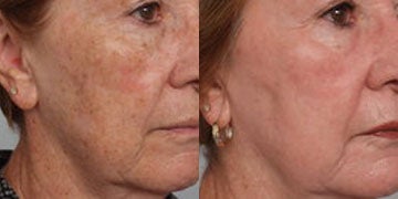 Age Spots Treatment