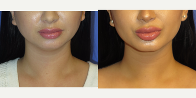 29 year old woman treated with Chin Liposuction and Chin Implant - 29 year old female who did not like the fullness of her neck and her recessive chin. She had Chin and Neck Liposuction and a Chin Augmentation with a large anatomical chin implant. Note how her neck is much more defined, the double chin is gone, and more balance in her profile.