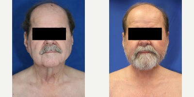 Neck Lift surgery for Excess Skin Removal and Defined Neck Contour - Our patient is a 75-year-old White male who came to Dr. Timothy Katzen because the loose, hanging skin beneath his chin and along his neck had become increasingly noticeable with age. He felt the extra neck skin made him look older than he felt and wanted a smoother, more refined profile. To address this concern, Dr. Katzen performed a neck lift, also known as a lower rhytidectomy, under general anesthesia. A neck lift is designed to improve the necks contour by removing excess skin, tightening the underlying tissues, and restoring a firmer transition from the jawline into the neck. During surgery, Dr. Katzen carefully planned the incisions to be placed in natural creases and around the ears whenever possible. The loose neck skin was elevated, the deeper tissues were tightened to improve support, and the excess skin was trimmed away in a controlled manner. This allows the neck to look smoother without appearing overly tight or unnatural. In patients with aging neck changes, a lower rhytidectomy can reduce the appearance of sagging skin, improve the neck angle, and create a cleaner side profile. The incisions were then closed in layers to support healing and help scars mature as discreetly as possible. These photos were taken 2 and a half years after surgery, and his results remain remarkable and sustained, showing a smoother neck contour, less hanging skin, and a more youthful appearance that has held up beautifully over time.