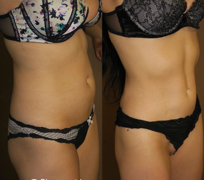 Patient treated with Liposuction - Amazing before and after of Liposuction to the abdomen and flanks accompanied by J Plasma. Liposuction is a great option for those hard to workout areas.