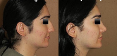 Patient treated with Rhinoplasty - The goal of this rhinoplasty was not only to correct the bridge and create a beautiful shape but to give her a more feminine nose that suited her face