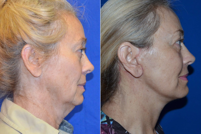 65-74 year old woman treated with Chin Implant - This woman came in with desires to rejuvenate her look. After having a consultation, she elected to have the Facelift/Necklift procedure with laser resurfacing and a pre-jowl implant.