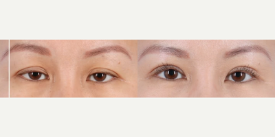 Woman treated with Ptosis Surgery - She underwent an Upper Blepharoplasty and a necessary Ptosis Repair to recreate a natural tapered crease. Needless to say, this dramatically changed her look for the better! Photos shown above are 6 months post-op.
