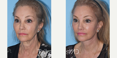 65-74 year old woman treated with Facelift - Extended Deep Plane Facelift, Full face eCO2 laser resurfacing & Lip lift