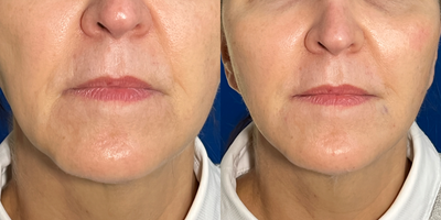 45-54 year old woman treated with Dermal Fillers, Liquid Facelift, Radiesse, RHA Collection Fillers, Xeomin - Before : Deflation of the cheeks and jaw volume .. deep nasolabial folds or parentheses Scalloped jawline Droopy corners of mouth Chin irregularity Prominent Neck Bands Procedure Radiesse .. RHA (Teoxane) fillers were placed to lift .. Smooth .. Replace lost Volume cheek , jawline chin volume Xeomim/Botox to soften neck bands, lift corners of the mouth and decrease cobblestone chin appearance Www.artofplasticsurgery.com