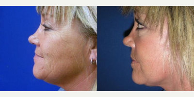 45-54 year old woman treated with Facelift - 52 year old female 4 months after a mini-facelift with simultaneous fat grafting and neck liposuction.