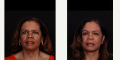 55-64 year old woman treated with Facelift, Neck Lift, Facial Fat Transfer, Eyelid Surgery, Brow Lift - This beautiful patient is now 3 months out from face and neck lift, brow lift, upper blepharoplasty and facial fat grafting! She has been so patient during the healing process and we're so happy she's loving the results so far. We're so glad she trusted us with the surgery. Thank you to her for letting us share these photos!