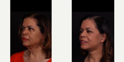 55-64 year old woman treated with Facelift, Neck Lift, Facial Fat Transfer, Eyelid Surgery, Brow Lift - This beautiful patient is now 3 months out from face and neck lift, brow lift, upper blepharoplasty and facial fat grafting! She has been so patient during the healing process and we're so happy she's loving the results so far. We're so glad she trusted us with the surgery. Thank you to her for letting us share these photos!