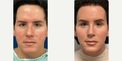 Woman treated with Genioplasty - Woman treated with Genioplasty