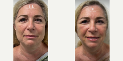 Woman treated with Deep Plane Facelift - Woman treated with Facelift Revision, Deep Plane Facelift, and Neck Lift, shown 2 weeks post op. Patient previously had Face lift, Neck lift, Eyelid Surgery through upper and lower blepharoplasty and Facial Fat Transfer done by another surgeon.