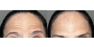 45-54 year old woman treated with Botox - When we do a botox application, we do it with a proprietary technique that allows us to give natural results without altering the facial expression. This technique is called multipoint microdosing and it involves applying small doses in multiple points and what is really important here is the form of application.