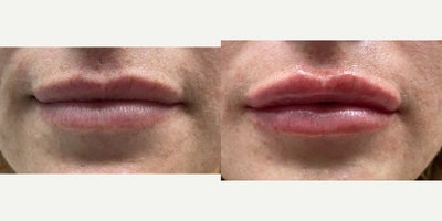 25-34 year old woman treated with Dermal Fillers - Restylane Kysse lip fillers with Dr. Wise for a natural-looking, yet plumper and more hydrated pout