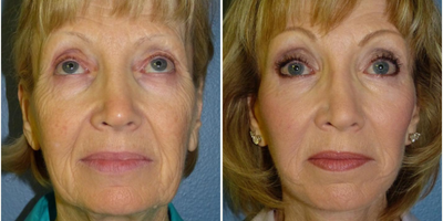 71 year old woman treated with Laser Resurfacing - 71 year old woman treated with CO2 Laser as well as SMAS Facelift, Neck Lift, and Facial Fat Transfer to treat laxity, volume depletion, and texture for overall facial rejuvenation. She is shown before and 6 months post op.
