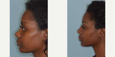 Woman treated with African American Rhinoplasty - Revision rhinoplasty for a patient who had undergone a previous rhinoplasty and desired to raise and narrow her bridge as well as create refinements to the nose. Revision rhinoplasty techniques included the raising of the bridge and the narrowing of the bridge with diced ear cartilage and temporalis fascia graft to avoid the placement of an implant in the nose. Tip support was created with a caudal septal extension graft and tip graft.