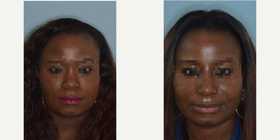 Woman treated with African American Rhinoplasty - Female patient who desired refinements to her nose. She desired to have a more elevated bridge, a narrowed tip and narrowing of the nasal base. Primary rhinoplasty techniques included bridge augmentation with diced auricular cartilage and temporalis fascia, tip onlay graft and alar base reductions.