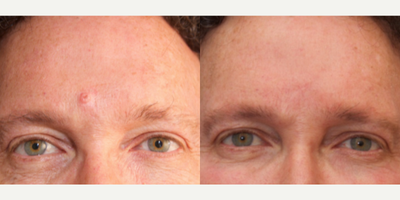 Man treated with Facial Reconstructive Surgery - Man treated with Facial Reconstructive Surgery