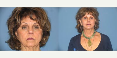 Quicklift w/neck liposuction - The patient is 6 months post Quicklift w/neck liposuction