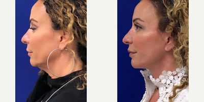 49 year old woman treated with Facelift - 49 year old woman treated with Lower Facelift with Neck Lift, Fat Transfer, Upper Eyelid Blepharoplasty and CO2 Laser Skin Resurfacing. Patient is shown before and 10 months post op.