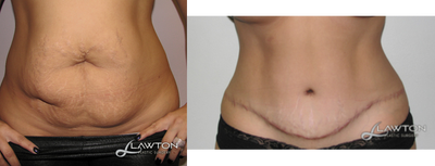 35-44 year old woman treated with Tummy Tuck - 6 months after tummy tuck
