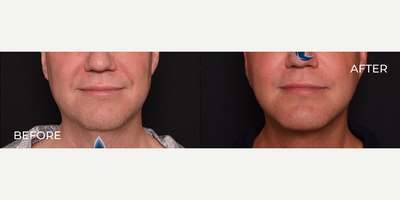 Man treated with Chin Filler - Man treated with Chin Filler