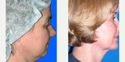 Woman treated with Facelift - LOWER FACELIFT