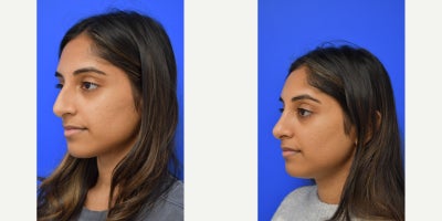 25-34 year old woman treated with Rhinoplasty - This beautiful 26 year old young lady desired a softer, more delicate nose.