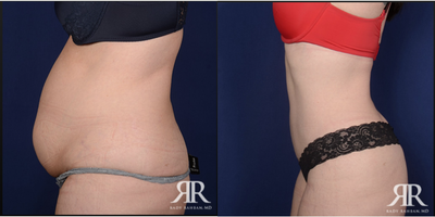 35-44 year old woman treated with Tummy Tuck - Tummy Tuck