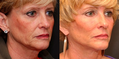 Woman treated with Mini Lift - Mini Facelift