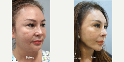 55-64 year old woman treated with Asian Rhinoplasty, Rhinoplasty, Revision Rhinoplasty, Facelift, Deep Plane Facelift, SMAS Face - 2 year post operative surgery before and after for 60-year-old female patientSurgery List:Extended deep plane faceliftNecklift, Middle neck plicationRib cartilage rhinoplasty, Mid face augmentationEndoscopic forehead & brow liftFull face fat graftingStem cell treatmentPerformed by VIP Plastic Surgery chief surgeon, Dr. Myung Ju Lee
