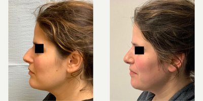 Woman treated with Rhinoplasty - Rhinoplasty