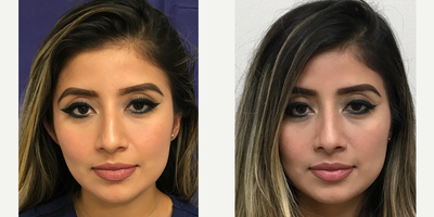Woman treated with Rhinoplasty - Rhinoplasty