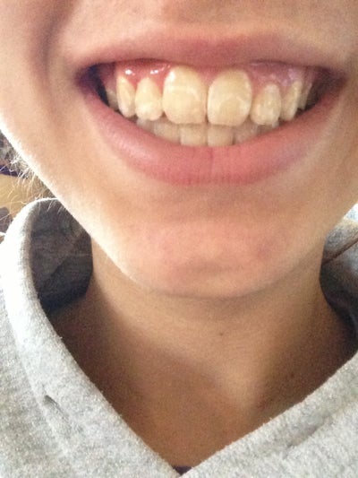 teeth braces fix got batoul ago realself