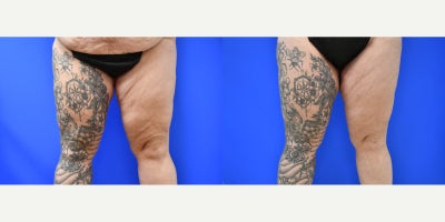 35-44 year old woman treated with Liposuction, Tummy Tuck - This 36 year old mother of 3 children had an abdominoplasty with suction assisted liposuction of her flanks and inner thighs. What a difference!! Check out her curves!