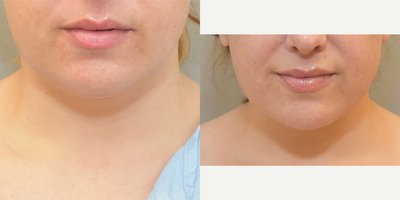 36 year old woman treated with Smart Lipo - Smart lipo neck