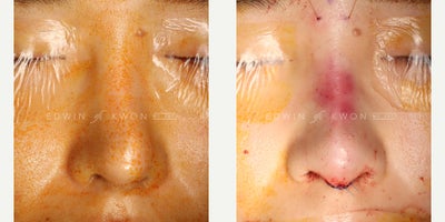 25-34 year old woman treated with Revision Rhinoplasty, DCF Rhinoplasty, Asian Rhinoplasty - 25-34 year old woman treated with revision DCF rhinoplasty. Patient had previously undergone primary rhinoplasty one year ago with silicone implant for the nasal bridge with rib cartilage used for the nasal tip. Her nose deviated and her nose no longer appeared straight. Patient also felt that her nose tip did not look natural. The silicone implant was removed as well as the capsule for the nasal bridge. This was replaced with a DCF graft utilizing rib cartilage and temporalis fascia. The nasal tip was reconstructed by recycling the previously placed rib grafts. The nasal tip projection was decreased slightly and a cap graft with ear cartilage was used to soften the nasal tip. The nose now appears straight with a natural appearing nasal tip.