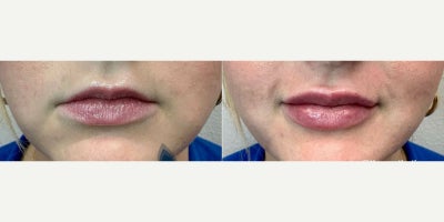Woman treated with Lip Fillers - Woman treated with Lip Fillers.