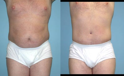 Male Abdominoplasty - Male Abdominoplasty, Male Tummy Tuck