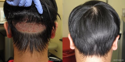 Stealth technique of the robotic FUE hair transplantation - This is an example of a stealth donor site for a FUE hair transplantation - insted of a typical short haircut that is required for a FUE hair follicle harvesting small area was used and patient can resume normal life almost immediately (the same technique is typically used for female patients)
