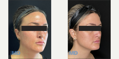 35-44 year old woman treated with Morpheus8 - Morpheus8 RF Microneedling -- tightens skin and induces collagen production!