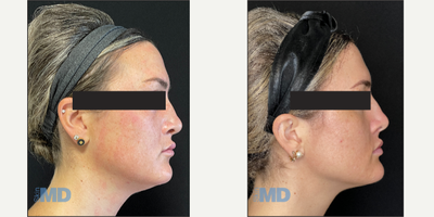 35-44 year old woman treated with Morpheus8 - Morpheus8 RF Microneedling -- tightens skin and induces collagen production!