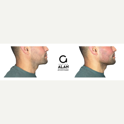 25-34 year old man treated with Ultherapy, Dermal Fillers, Radiesse - This is a non invasive treatment with microfocused ultrasound technology and visualization. Helps achieve a fresher, more youthful look from the eyebrows to the cleavage. Improves skin appearance. Generates skin retraction. Optimize collagen production. Improves tone and texture. Oxygenates and provides hydration to the treated areas.