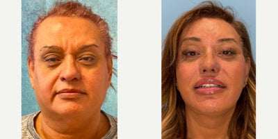 55-64 year old transgender woman treated with Facial Feminization Surgery - Facial Feminization