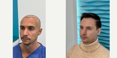 25-34 year old man treated with DHI Hair Transplant - This case shows the result at 6 months after a DHI hair transplant performed at FullFace Clinic.At this stage, approximately 4050% of the final result is visible. The transplanted hair has entered the active growth phase, with noticeable improvement in density and coverage compared to the early post-operative period. Hair growth is becoming more consistent, although full maturation of thickness and texture is still ongoing.The procedure was performed using the DHI (Direct Hair Implantation) technique, allowing precise control over graft placement, angle, and direction. This contributes to a natural-looking hairline and harmonious integration with existing hair.At 6 months post-op, further improvements are expected, particularly in hair thickness and overall density, with the final result typically assessed between 9 and 12 months after the procedure.The donor area shows good healing with preserved density and no visible scarring. The patient reports a smooth recovery process and is satisfied with the progress achieved at this stage.