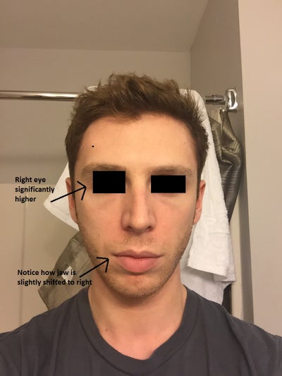 No Facial Asymmetry 44