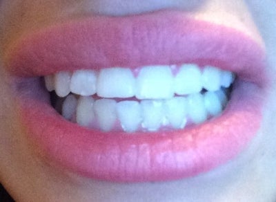 teeth shifted after not wearing retainer