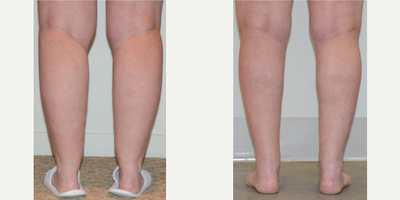 35-44 year old woman treated with Liposuction - This woman was dissatisfied with the contour and proportions of her lower legs. This shape was present for as long as she can remember, and was not improved with weightloss or exercise. She was treated with circumferential liposuction contouring of the calves and ankles. This created definition of the calf muscles, slimmer lower legs and ankles, and a tapered look down into the ankle region.