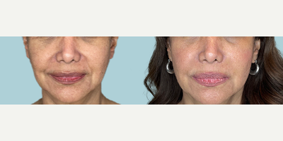 45-54 year old woman treated with Radiesse, Dermal Fillers - The application of hyaluronic acid is performed with personalized techniques to restore or give volume and elasticity in a natural way to the folds and deep wrinkles that present in the skin. The results are progressive, they are seen from its application but after 15 days the final result is reflected.