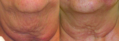 Venus Legacy - Before and After 5 Treatments.  Photos provided courtesy of Venus Concept.