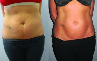 Venus Legacy - Before and After 8 Treatments.  Photos provided courtesy of Venus Concept.